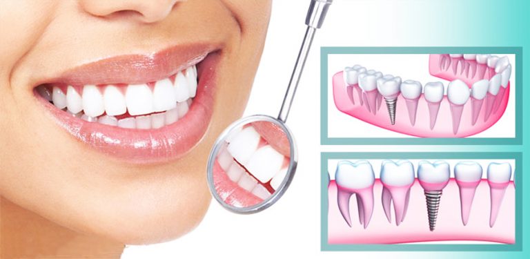 (P) Avantajele implanturilor dentare